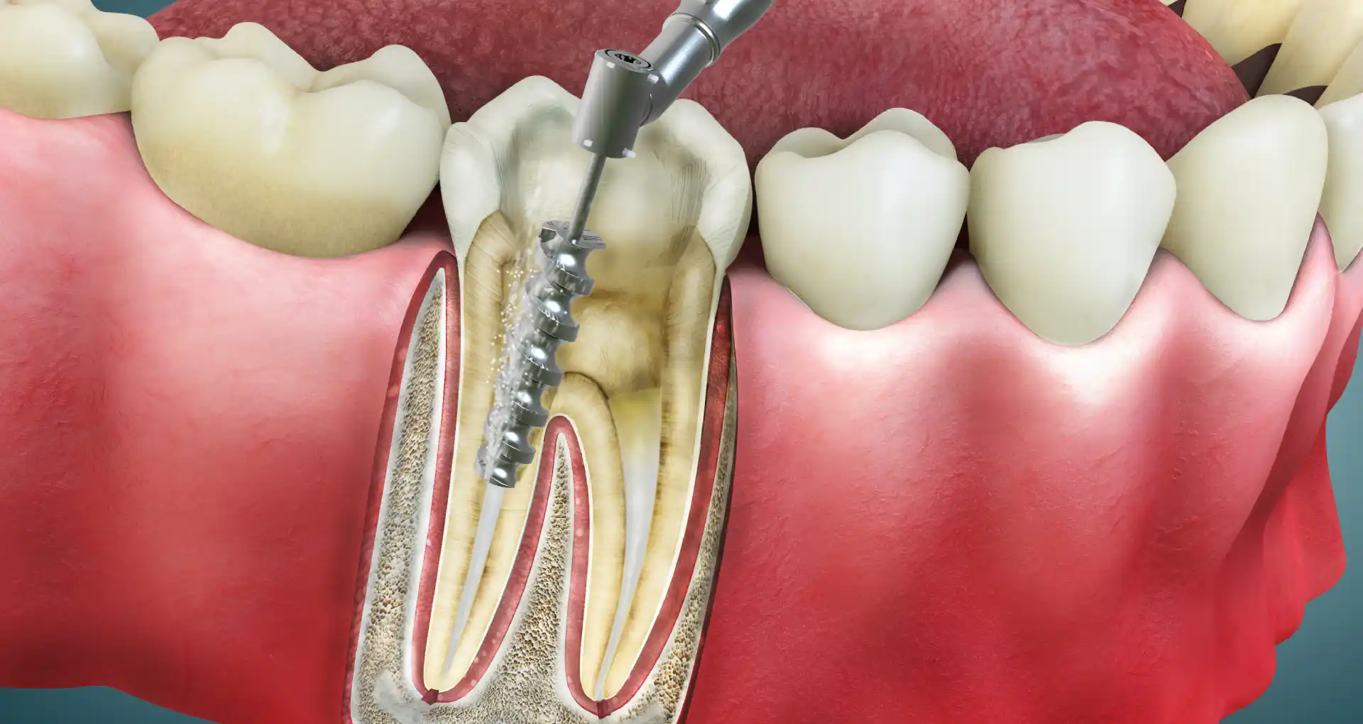 Root Canal Treatment: Myths, Facts & Comfort